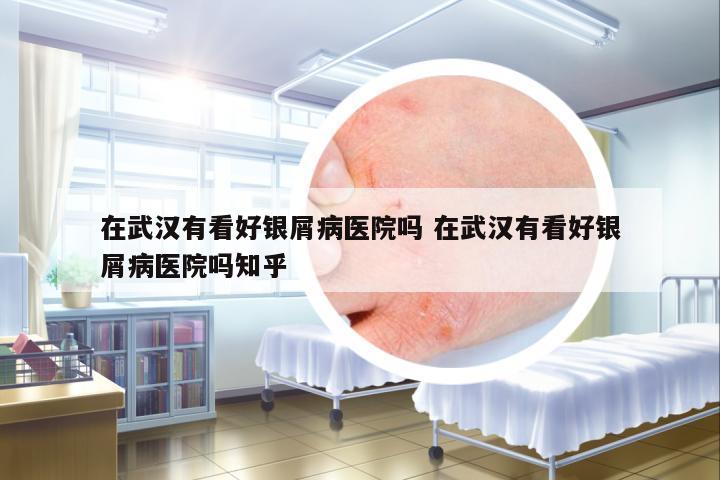 在武漢有看好銀屑病醫(yī)院嗎 在武漢有看好銀屑病醫(yī)院嗎知乎