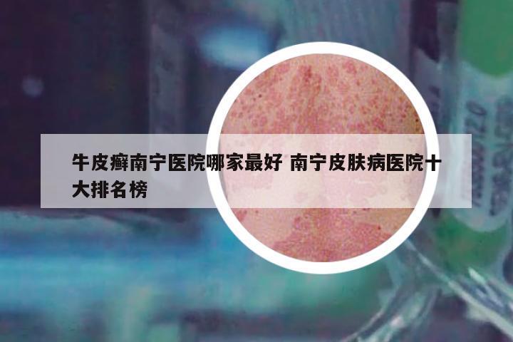 牛皮癬南寧醫(yī)院哪家最好 南寧皮膚病醫(yī)院十大排名榜