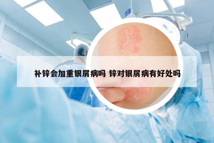 補(bǔ)鋅會(huì)加重銀屑病嗎 鋅對(duì)銀屑病有好處嗎