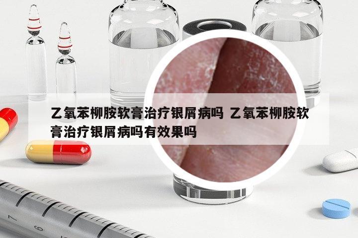 乙氧苯柳胺軟膏治療銀屑病嗎 乙氧苯柳胺軟膏治療銀屑病嗎有效果嗎