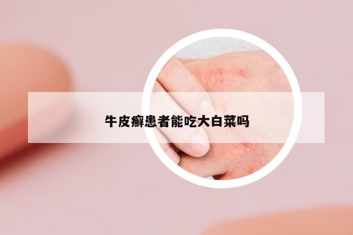 牛皮癬患者能吃大白菜嗎