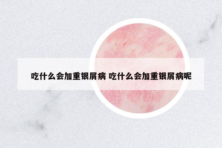 吃什么會(huì)加重銀屑病 吃什么會(huì)加重銀屑病呢
