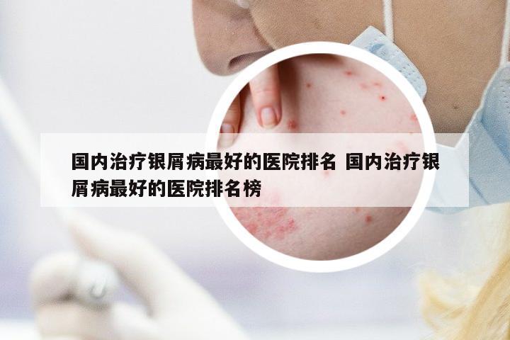 國內(nèi)治療銀屑病最好的醫(yī)院排名 國內(nèi)治療銀屑病最好的醫(yī)院排名榜