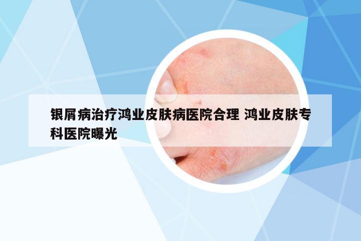 銀屑病治療鴻業(yè)皮膚病醫(yī)院合理 鴻業(yè)皮膚專科醫(yī)院曝光