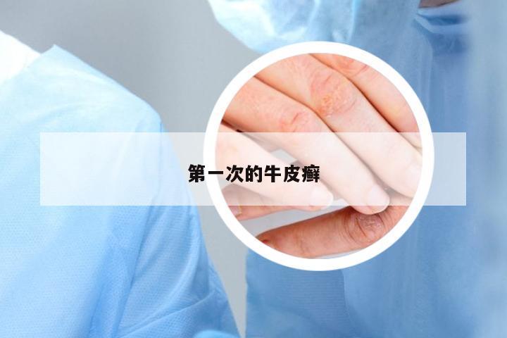 第一次的牛皮癬