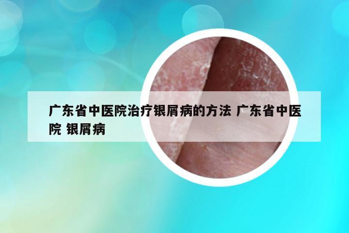 廣東省中醫(yī)院治療銀屑病的方法 廣東省中醫(yī)院 銀屑病