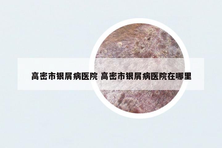 高密市銀屑病醫(yī)院 高密市銀屑病醫(yī)院在哪里