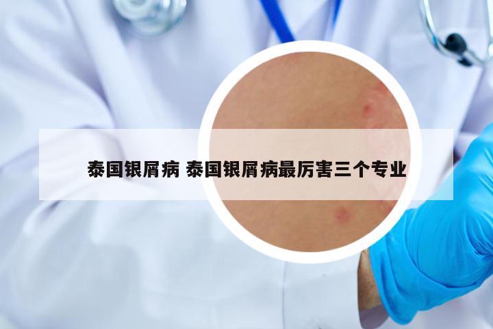 泰國(guó)銀屑病 泰國(guó)銀屑病最厲害三個(gè)專業(yè)