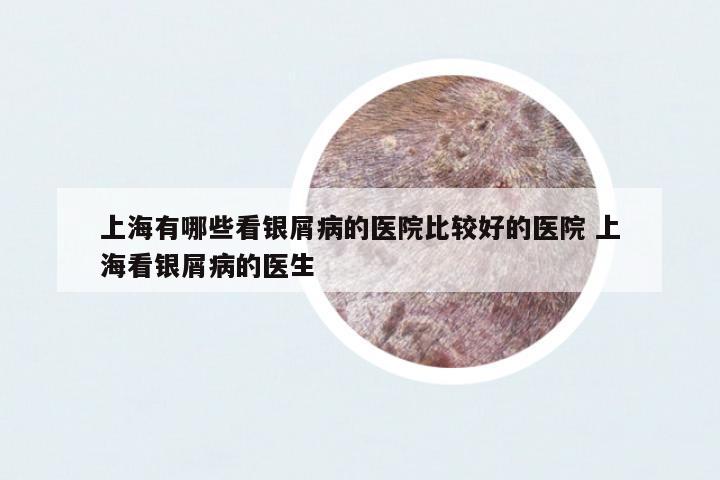 上海有哪些看銀屑病的醫(yī)院比較好的醫(yī)院 上海看銀屑病的醫(yī)生