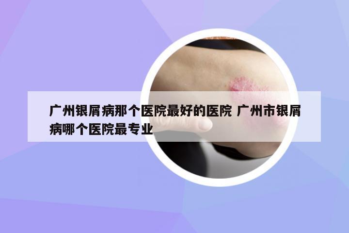 廣州銀屑病那個(gè)醫(yī)院最好的醫(yī)院 廣州市銀屑病哪個(gè)醫(yī)院最專業(yè)