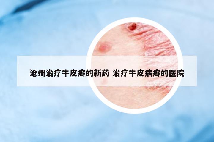 滄州治療牛皮癬的新藥 治療牛皮病癬的醫(yī)院