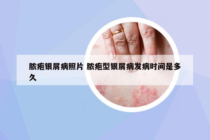 膿皰銀屑病照片 膿皰型銀屑病發(fā)病時間是多久