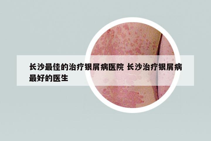 長(zhǎng)沙最佳的治療銀屑病醫(yī)院 長(zhǎng)沙治療銀屑病最好的醫(yī)生