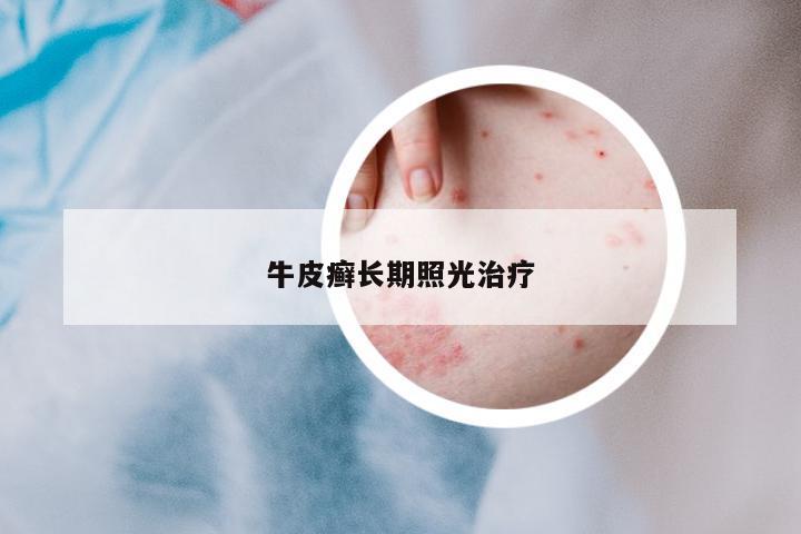牛皮癬長(zhǎng)期照光治療