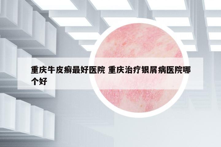 重慶牛皮癬最好醫(yī)院 重慶治療銀屑病醫(yī)院哪個好
