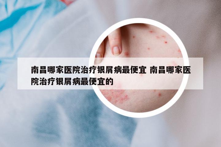 南昌哪家醫(yī)院治療銀屑病最便宜 南昌哪家醫(yī)院治療銀屑病最便宜的