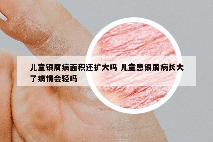 兒童銀屑病面積還擴(kuò)大嗎 兒童患銀屑病長大了病情會輕嗎