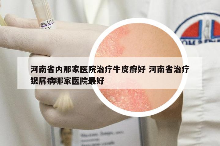 河南省內(nèi)那家醫(yī)院治療牛皮癬好 河南省治療銀屑病哪家醫(yī)院最好