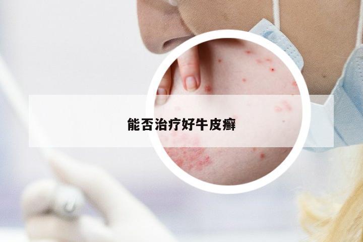 能否治療好牛皮癬