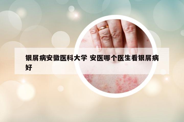 銀屑病安徽醫(yī)科大學 安醫(yī)哪個醫(yī)生看銀屑病好