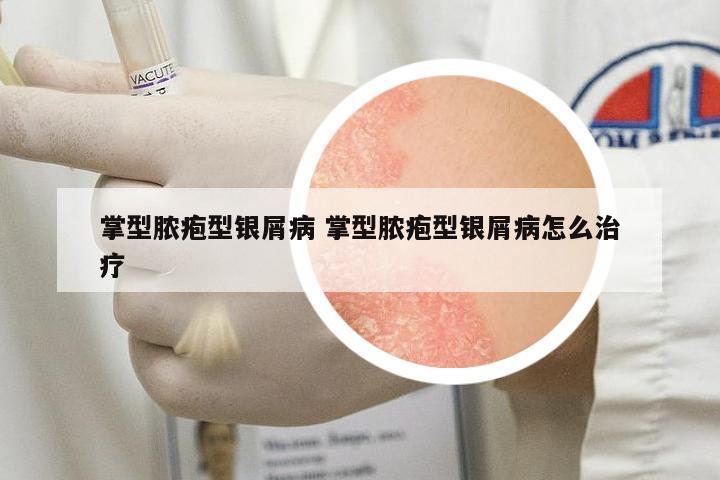 掌型膿皰型銀屑病 掌型膿皰型銀屑病怎么治療