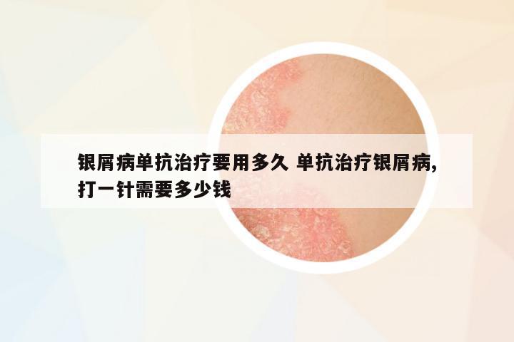 銀屑病單抗治療要用多久 單抗治療銀屑病,打一針需要多少錢(qián)