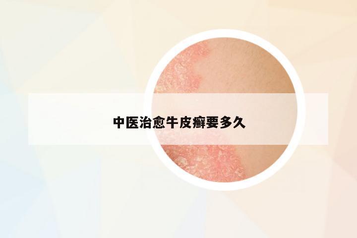 中醫(yī)治愈牛皮癬要多久