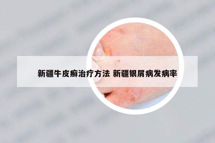 新疆牛皮癬治療方法 新疆銀屑病發(fā)病率