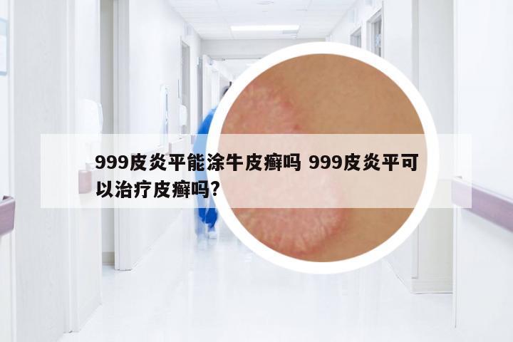999皮炎平能涂牛皮癬嗎 999皮炎平可以治療皮癬嗎?