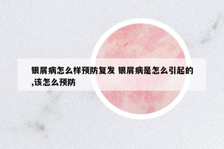 銀屑病怎么樣預(yù)防復(fù)發(fā) 銀屑病是怎么引起的,該怎么預(yù)防