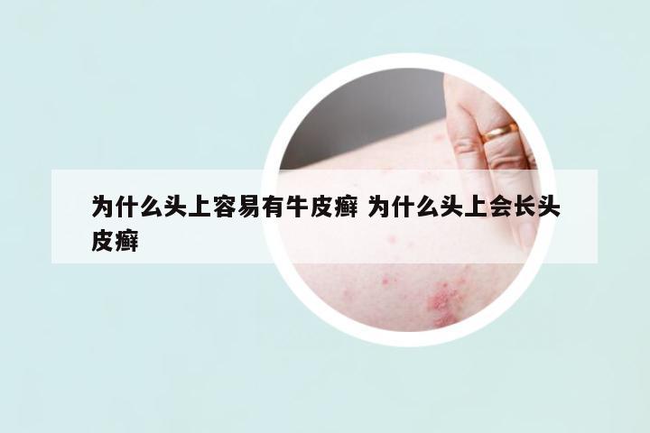 為什么頭上容易有牛皮癬 為什么頭上會(huì)長頭皮癬
