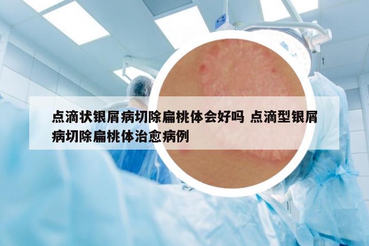 點滴狀銀屑病切除扁桃體會好嗎 點滴型銀屑病切除扁桃體治愈病例