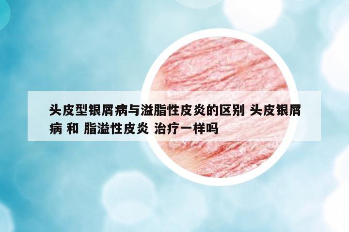 頭皮型銀屑病與溢脂性皮炎的區(qū)別 頭皮銀屑病 和 脂溢性皮炎 治療一樣嗎