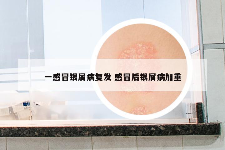 一感冒銀屑病復(fù)發(fā) 感冒后銀屑病加重