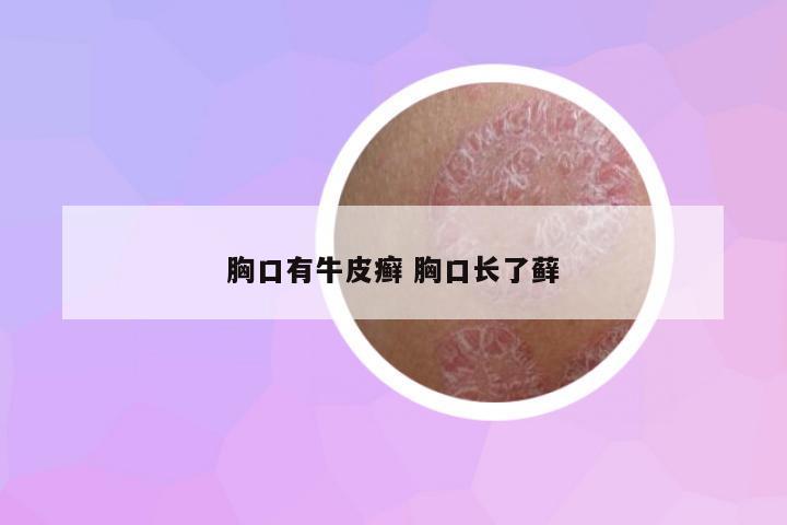 胸口有牛皮癬 胸口長了蘚