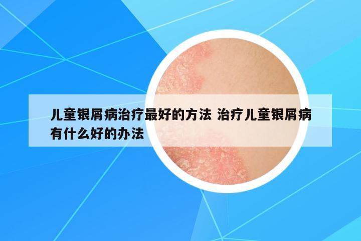 兒童銀屑病治療最好的方法 治療兒童銀屑病有什么好的辦法