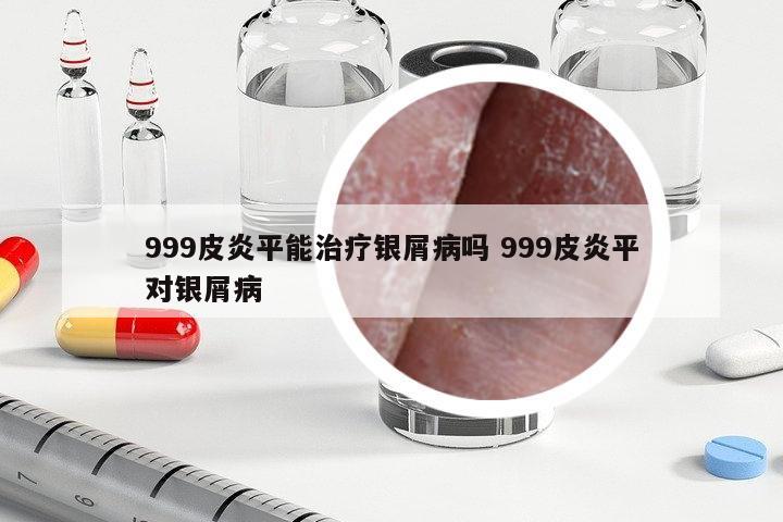 999皮炎平能治療銀屑病嗎 999皮炎平對銀屑病