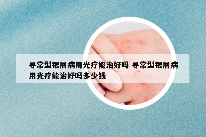 尋常型銀屑病用光療能治好嗎 尋常型銀屑病用光療能治好嗎多少錢
