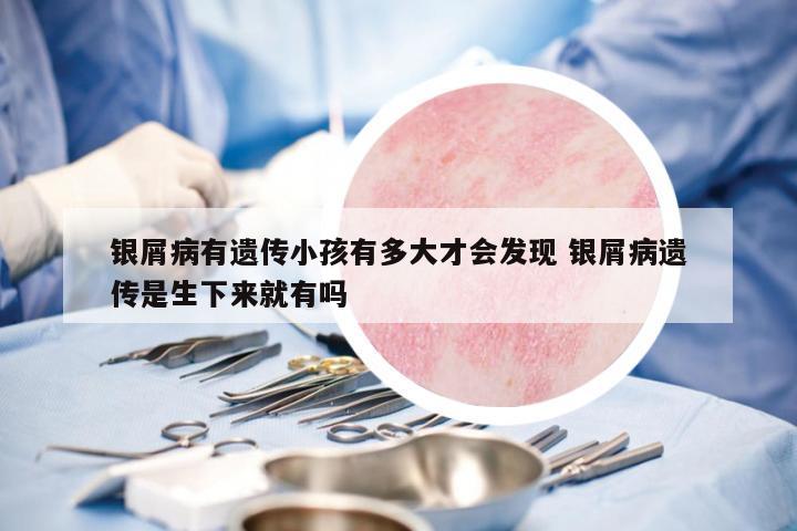 銀屑病有遺傳小孩有多大才會發(fā)現(xiàn) 銀屑病遺傳是生下來就有嗎