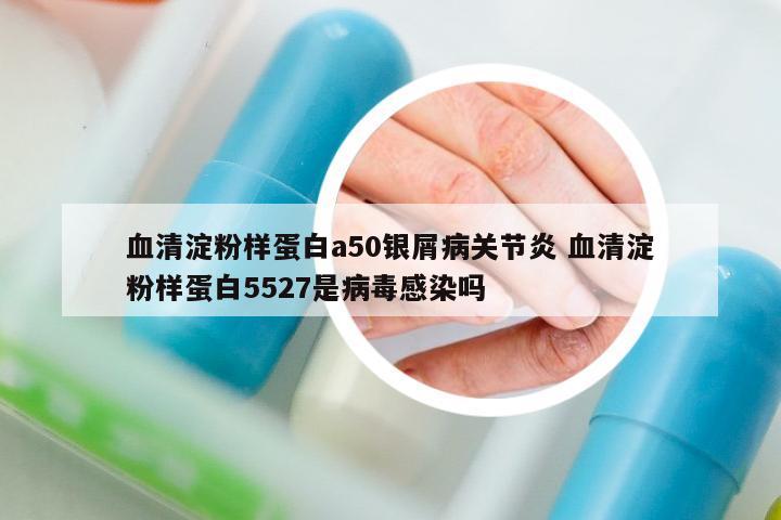 血清淀粉樣蛋白a50銀屑病關節(jié)炎 血清淀粉樣蛋白5527是病毒感染嗎