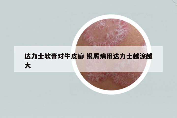 達(dá)力士軟膏對牛皮癬 銀屑病用達(dá)力士越涂越大