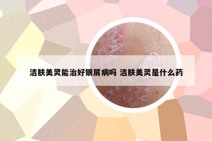 潔膚美靈能治好銀屑病嗎 潔膚美靈是什么藥