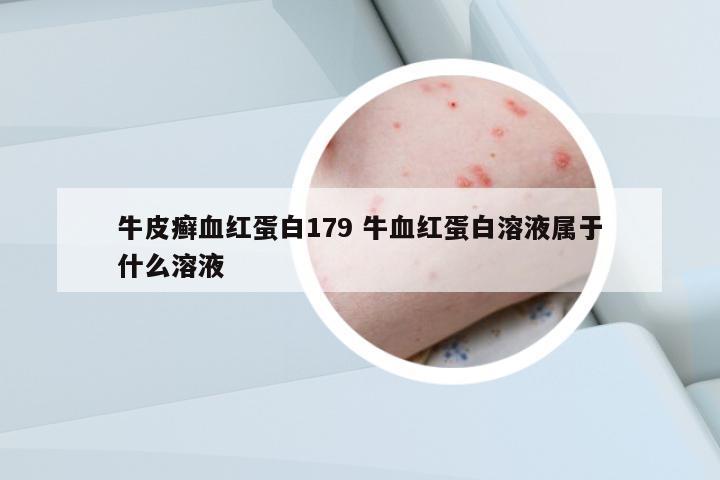 牛皮癬血紅蛋白179 牛血紅蛋白溶液屬于什么溶液