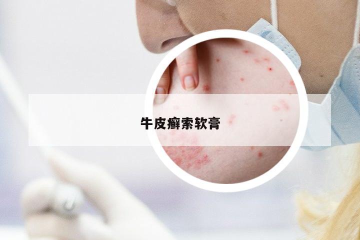 牛皮癬索軟膏