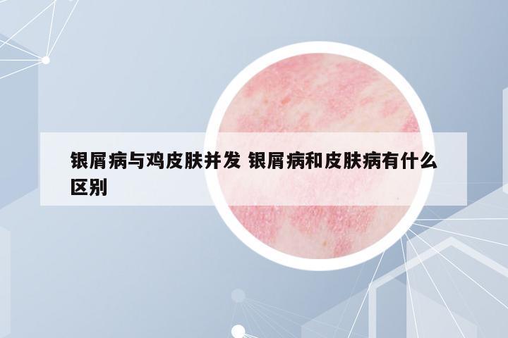 銀屑病與雞皮膚并發(fā) 銀屑病和皮膚病有什么區(qū)別