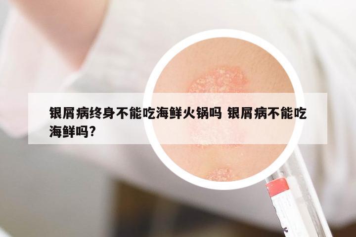 銀屑病終身不能吃海鮮火鍋嗎 銀屑病不能吃海鮮嗎?
