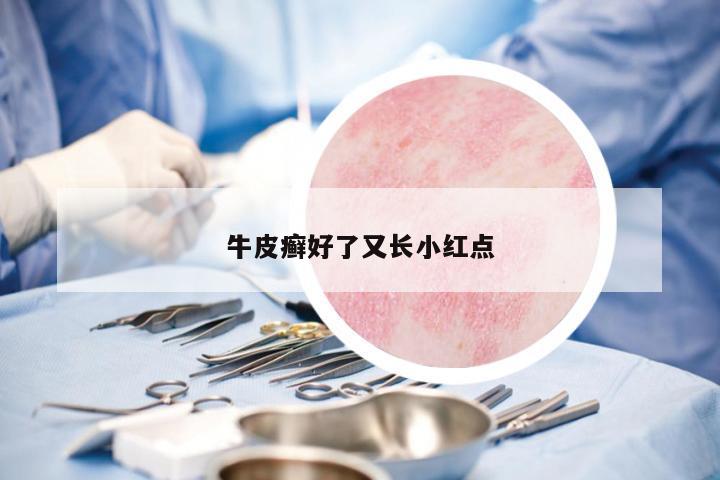 牛皮癬好了又長小紅點