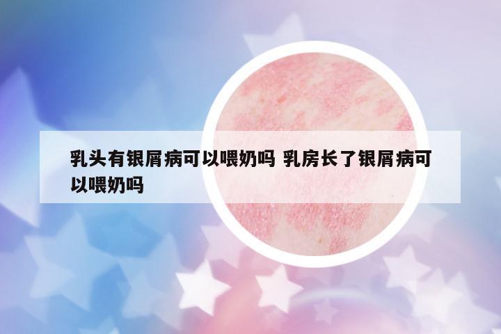 乳頭有銀屑病可以喂奶嗎 乳房長(zhǎng)了銀屑病可以喂奶嗎