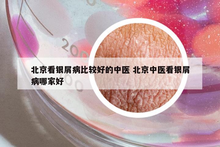 北京看銀屑病比較好的中醫(yī) 北京中醫(yī)看銀屑病哪家好