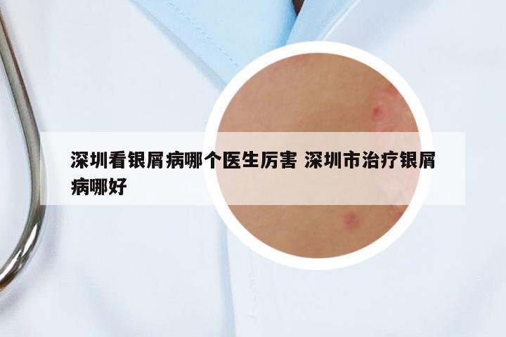 深圳看銀屑病哪個(gè)醫(yī)生厲害 深圳市治療銀屑病哪好